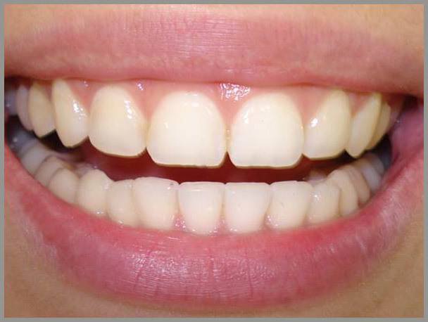 Gingival Recontouring After