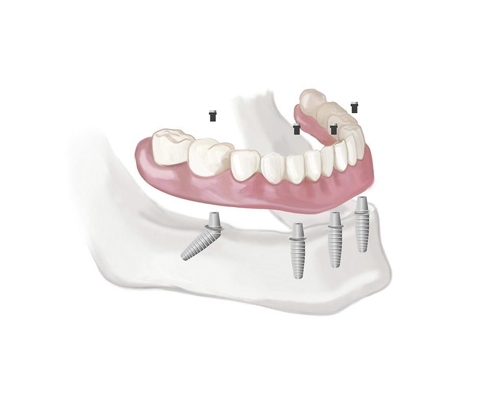 Dental Implants Procedure in North York