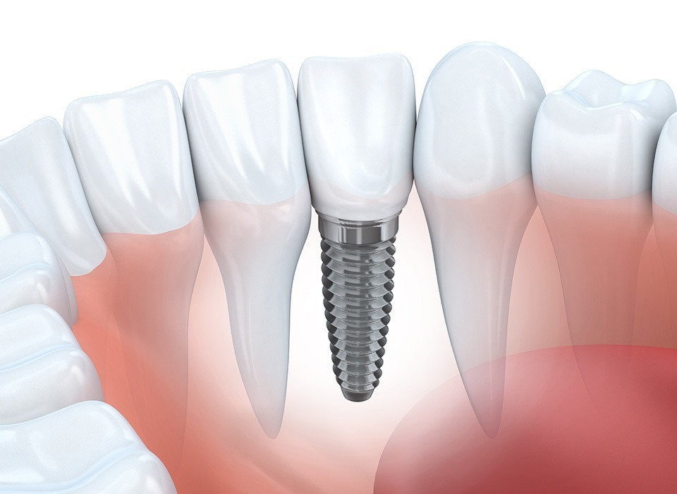 Dental Implants in North York