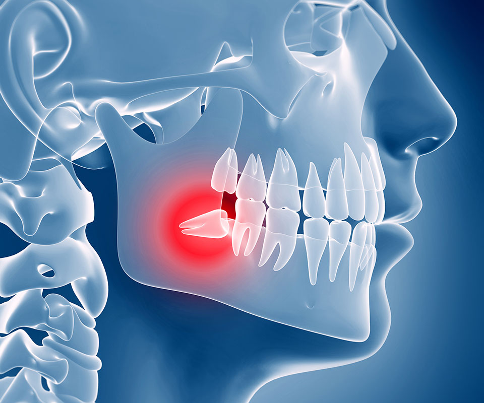 Wisdom Tooth Extractions North York