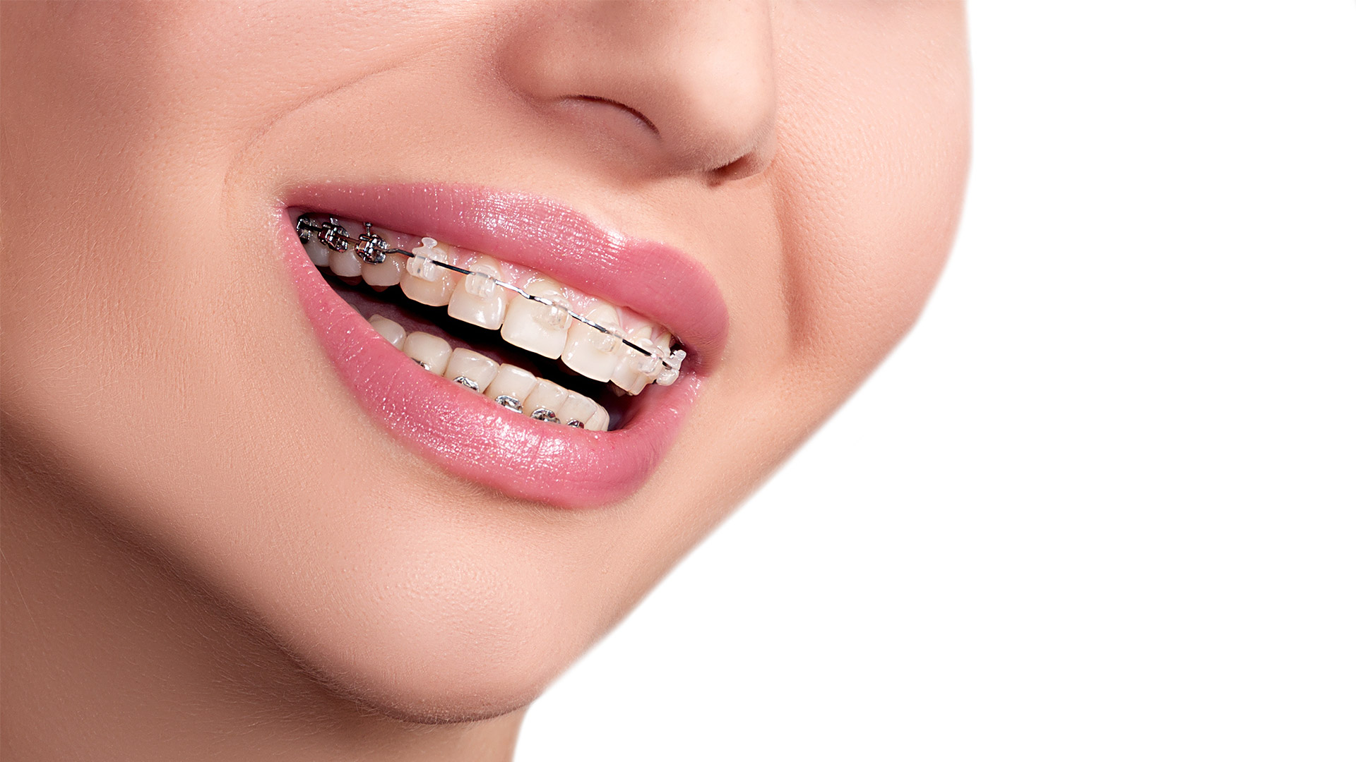 Translucent Cosmetic Braces  Greater Vancouver Orthodontics