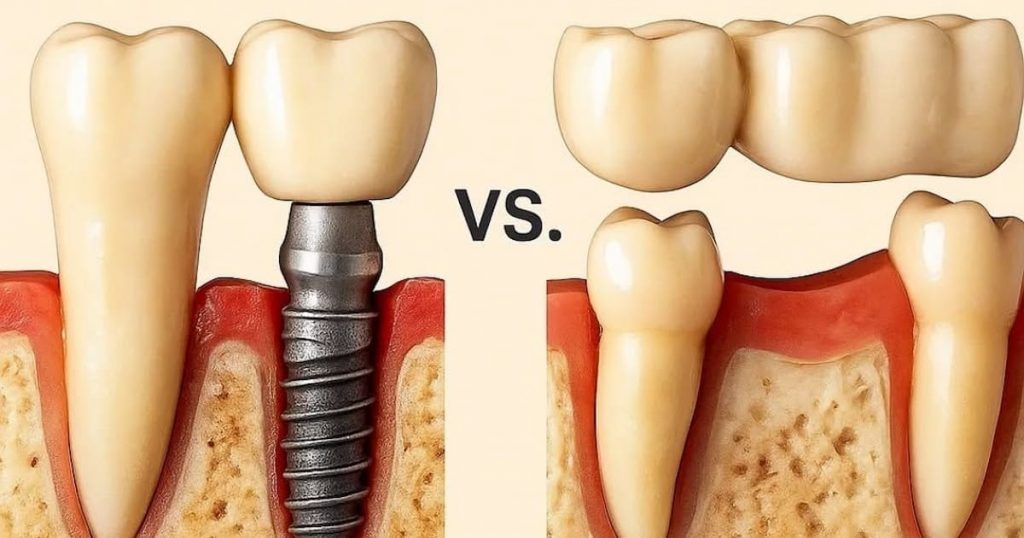 Implants vs Bridges