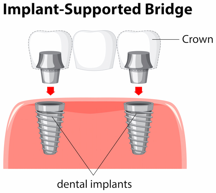 different parts of implants vs bridges