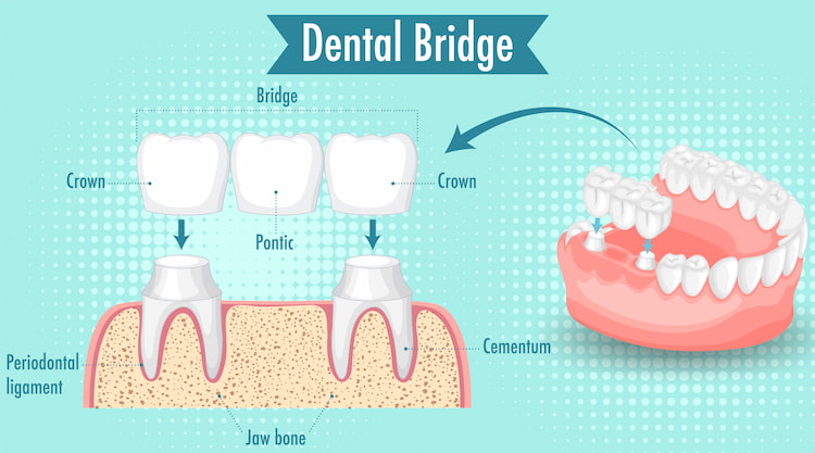 dental bridge parts