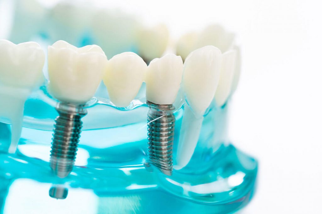 Dental Implants Do Not Depend on Neighbouring Teeth for Support