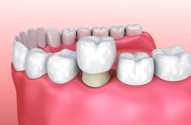 a dental implant process showing crown being placed on an abutment. 