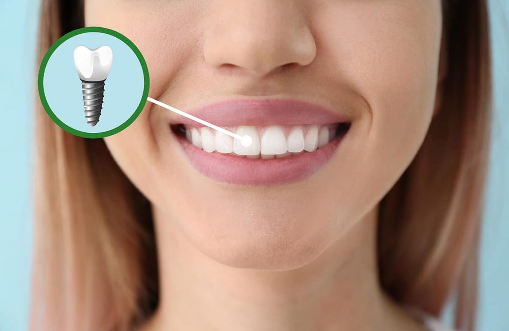 What Are the Main Benefits of Dental Implants?