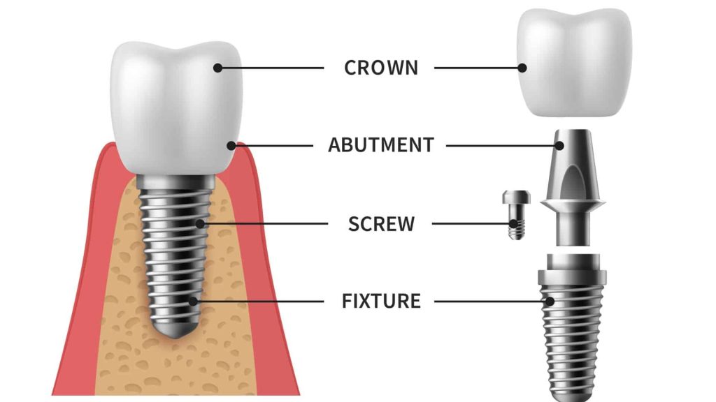 a dental implant structure