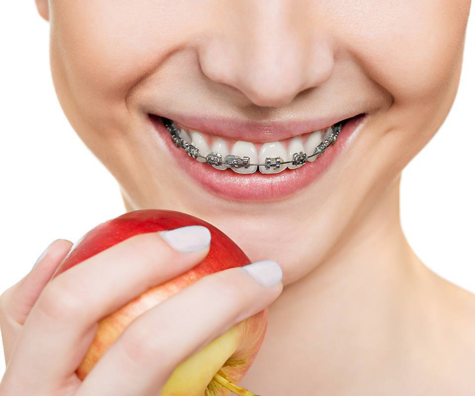 Woman eating an apple with orthodontic teeth