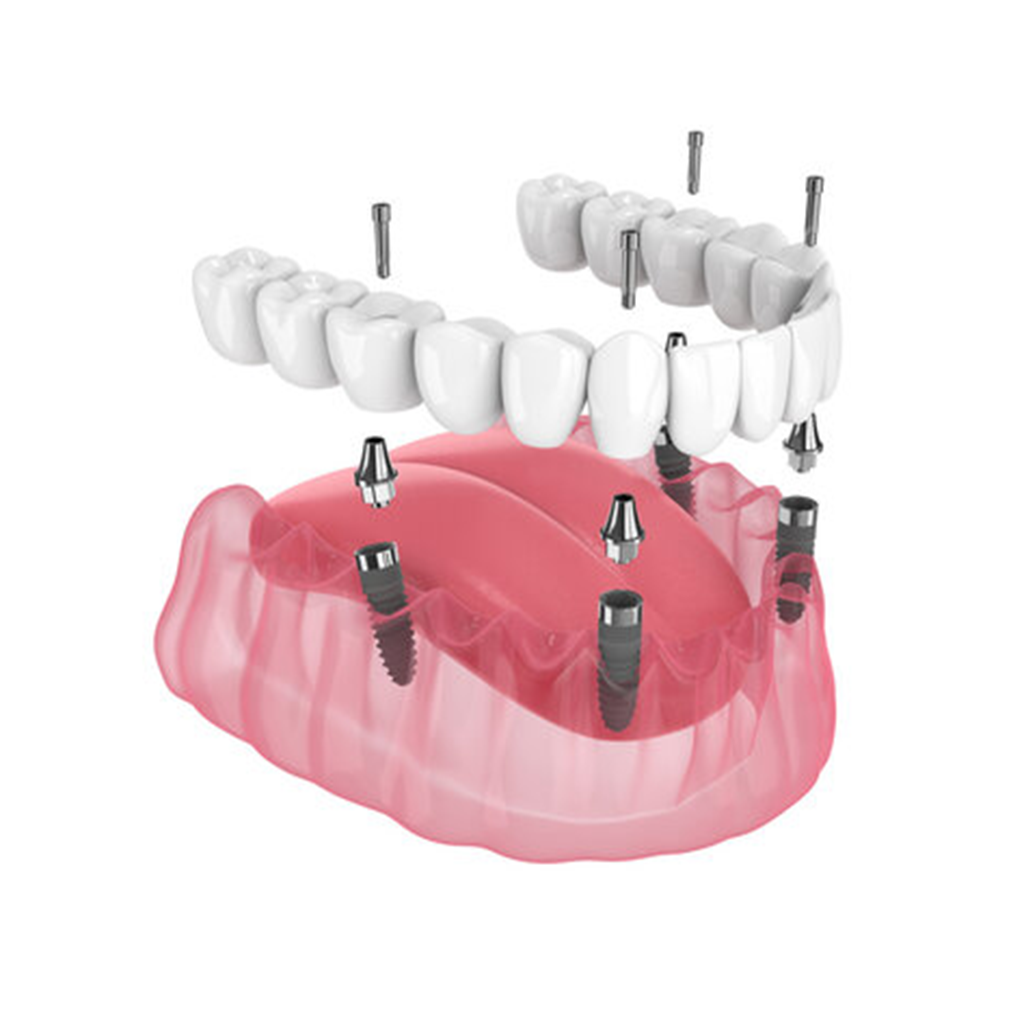 All-On-4 Dental Implants