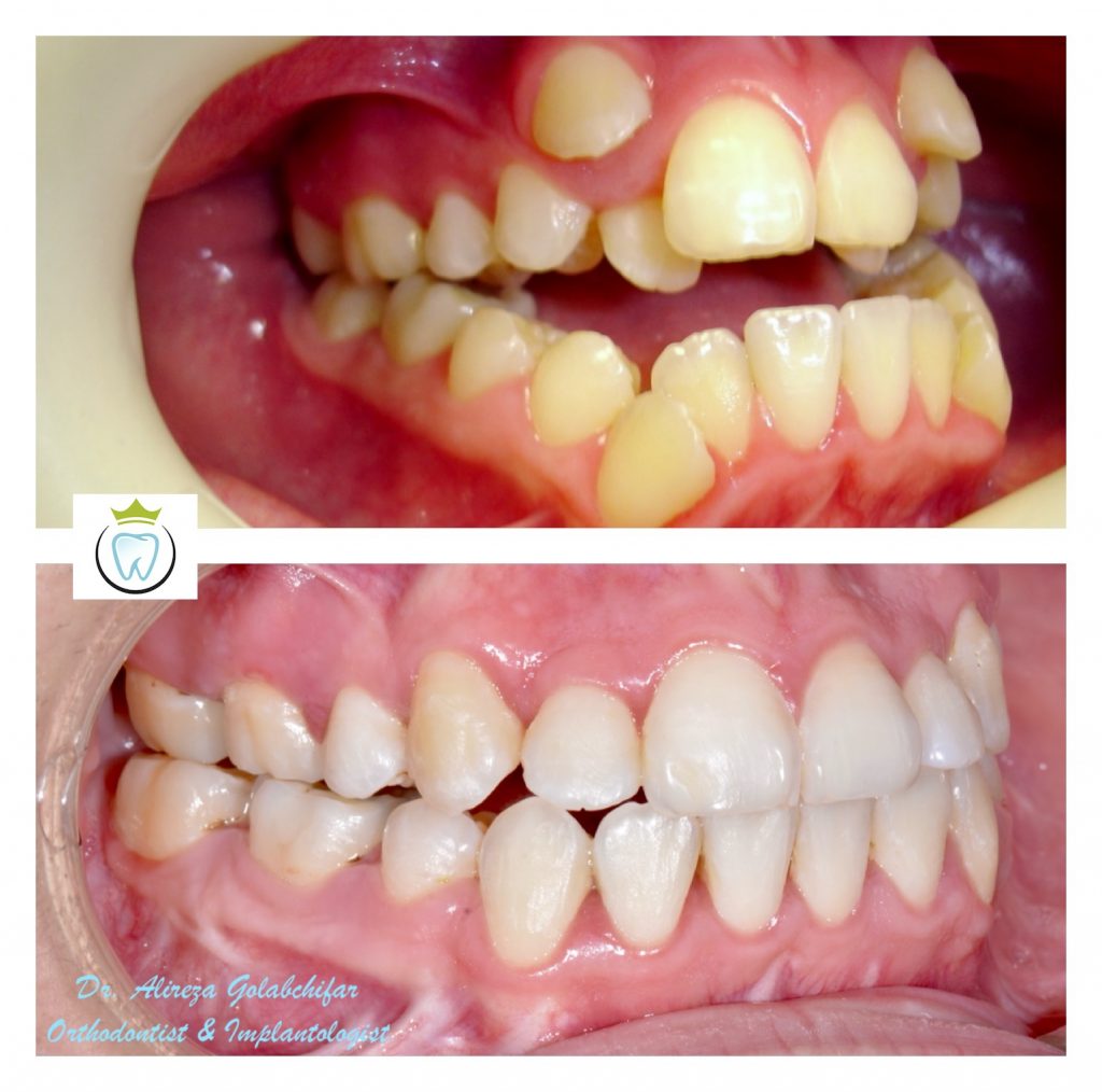 Before and after Claudiia Vidal's orthodontic teeth