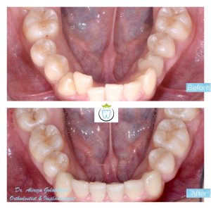 Before and after Katherine Chen's orthodontic teeth