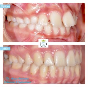 Before and after ava tayefi's orthodontic teeth