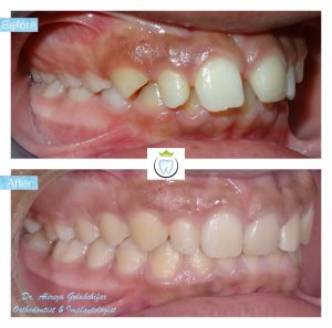 Before and after caleb's orthodontic teeth