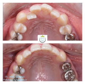 Before and after saya hirata's orthodontic teeth