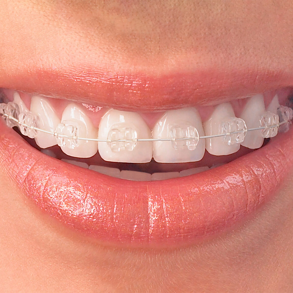 Ceramic Braces