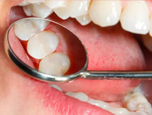 Dental Sealants