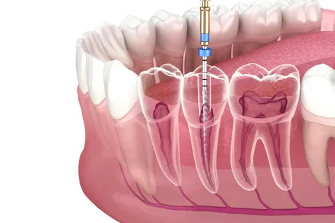 Emergency Root Canals for Relief from Severe Tooth Pain Caused by Deep Decay