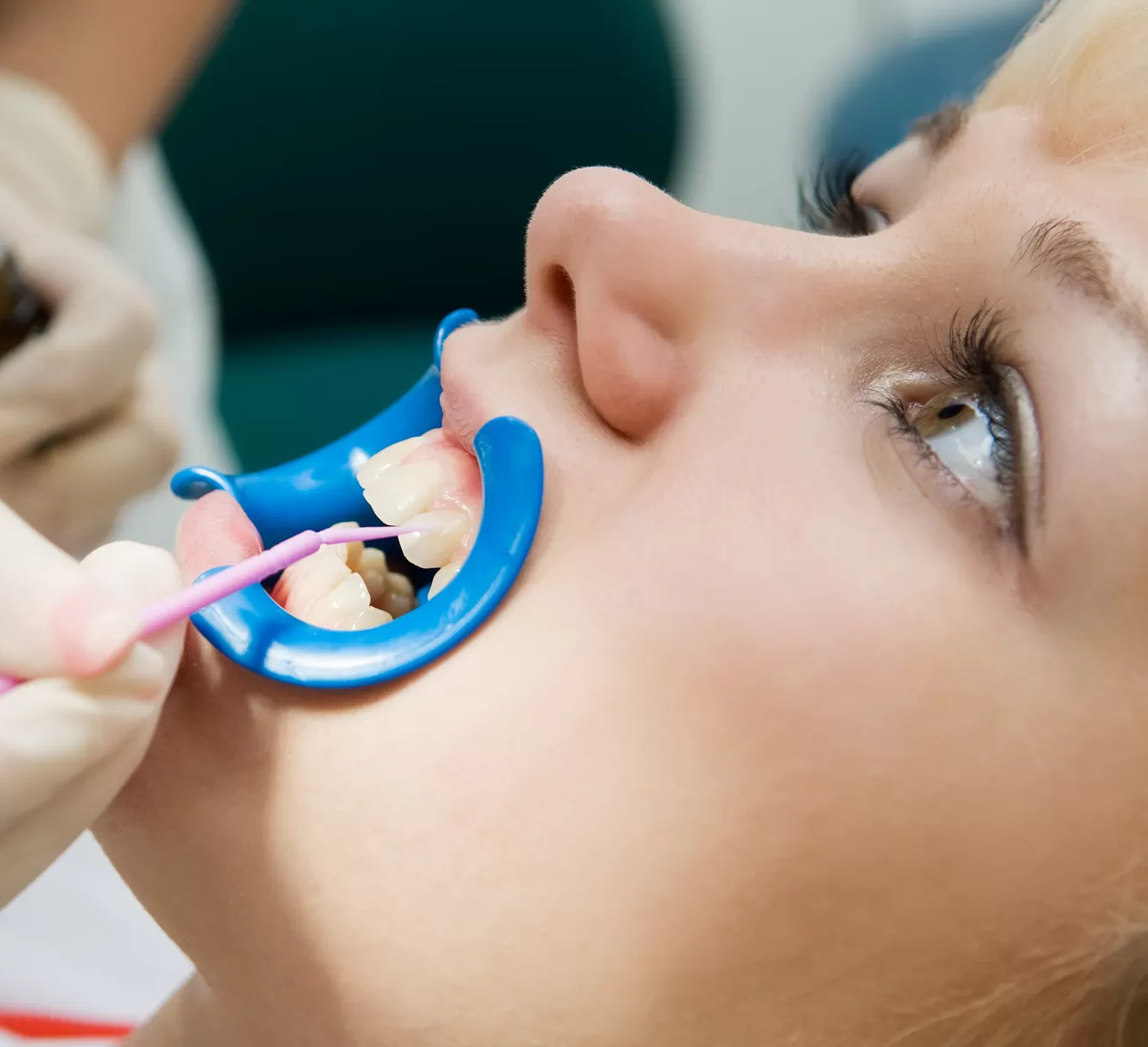 fluoride treatments