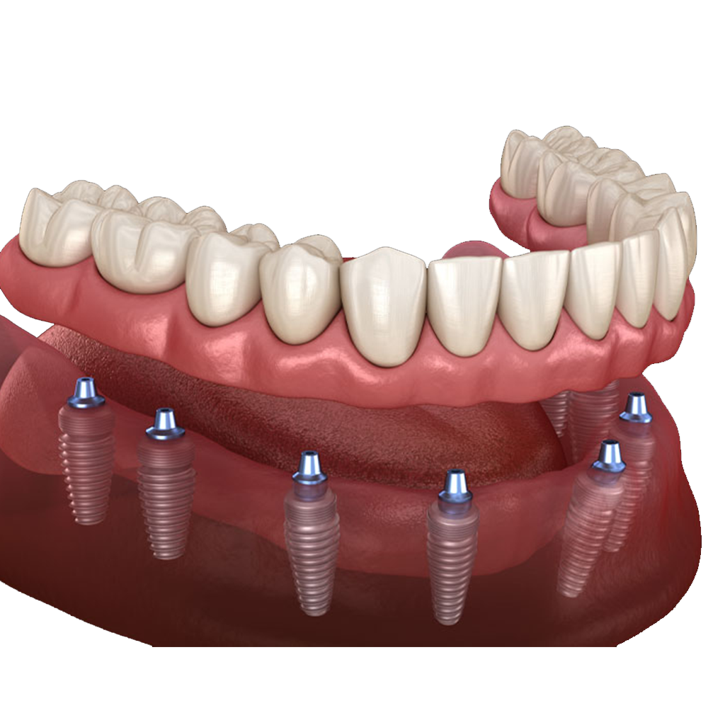 Full Mouth Reconstruction
