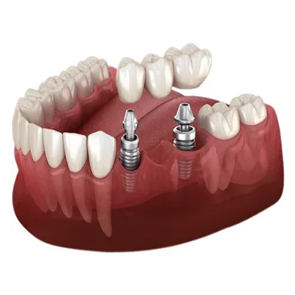Implant-Supported Bridges