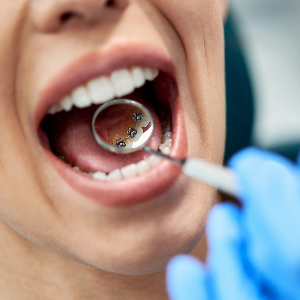 Lingual Braces