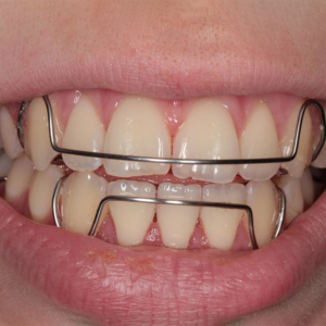 Retainer.jpg