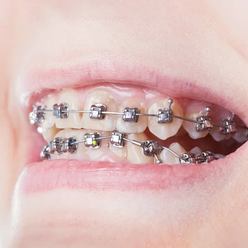 Self-Ligating Braces