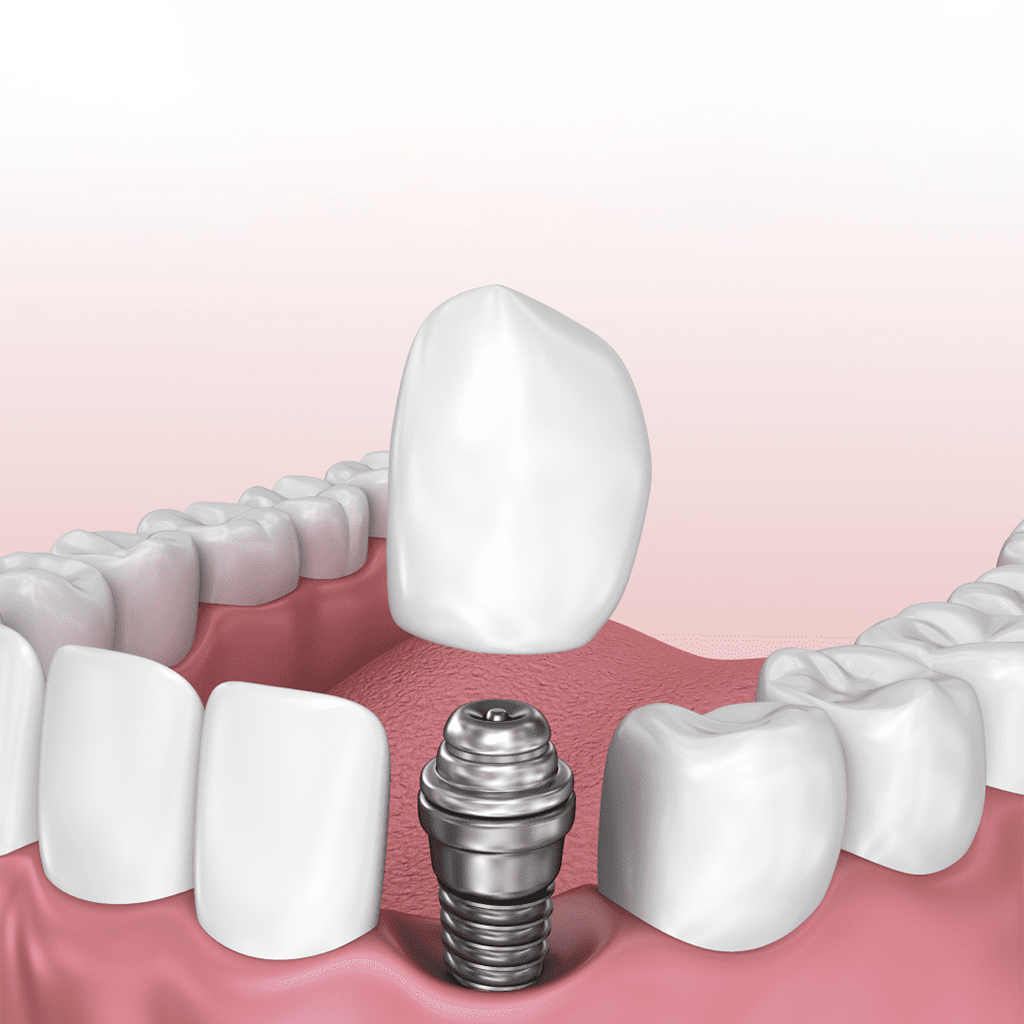 Single Tooth Implants