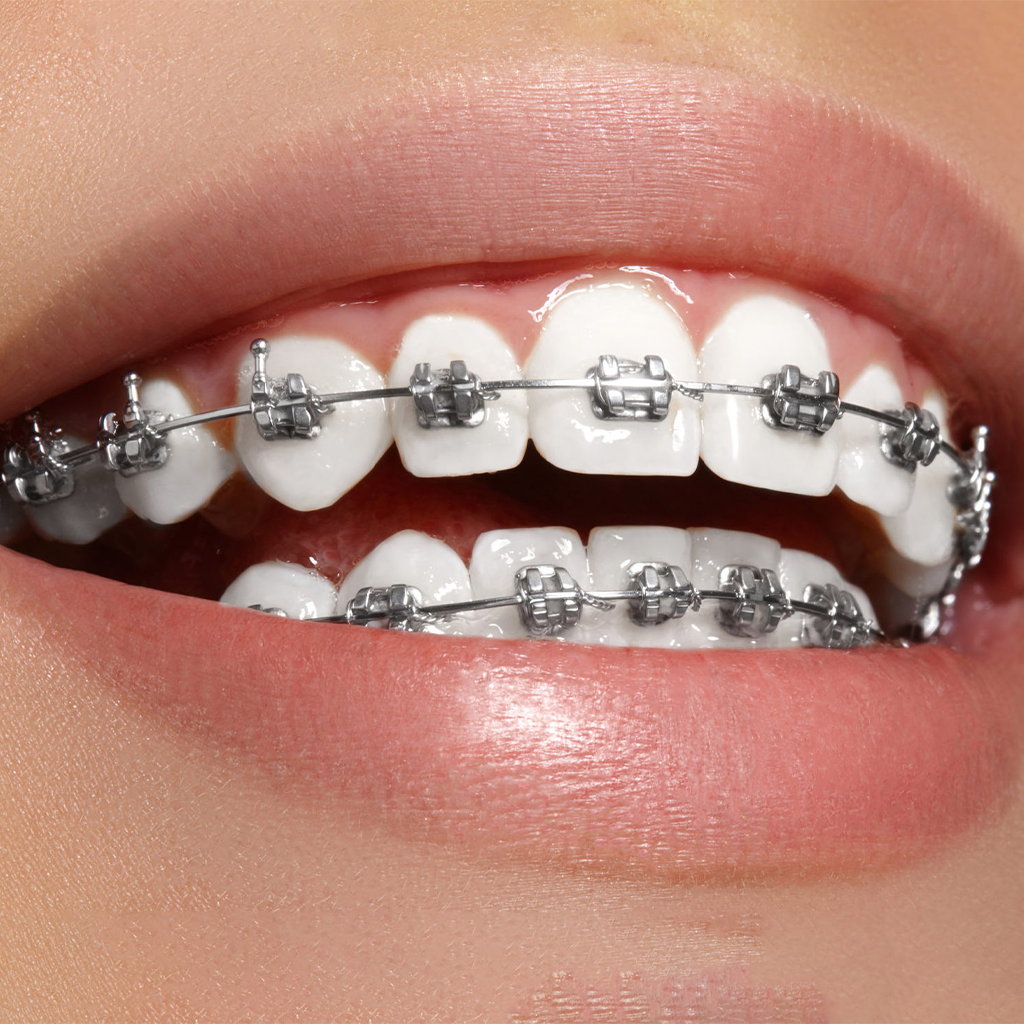 Traditional Metal Braces