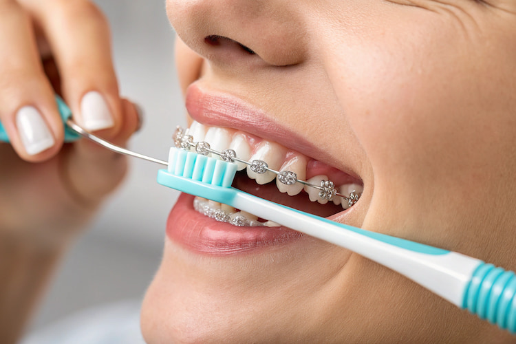 a woman brushing her teeth with braces the correct way