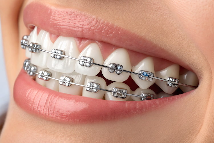 a photo showing how dental braces can enhance a person's smile and dental wellness