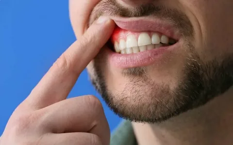 reatment for Dental Abscesses, Gum Infections, and Facial Swelling