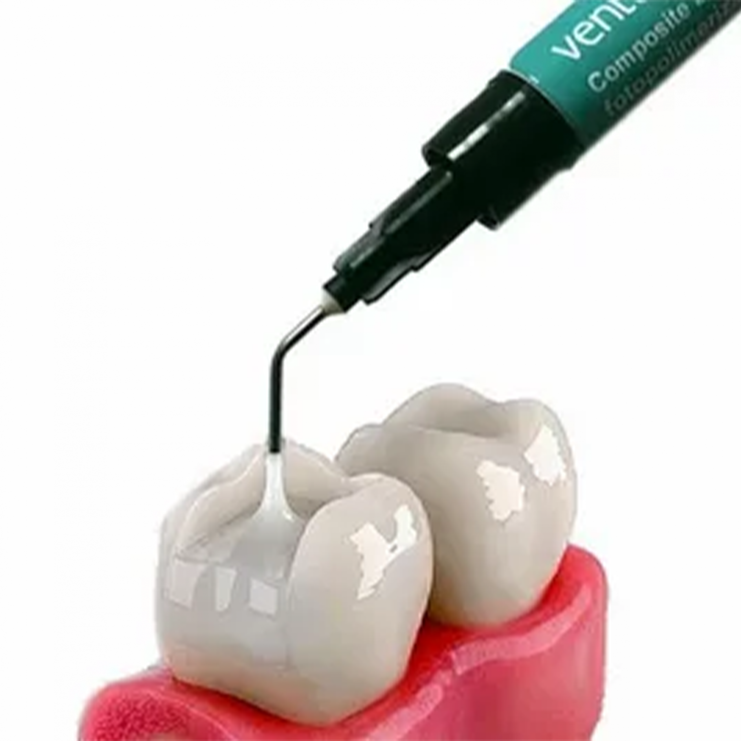 Laser Cavity Fillings: