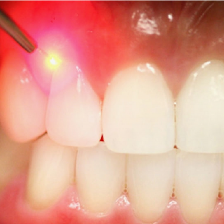 Gum Disease 