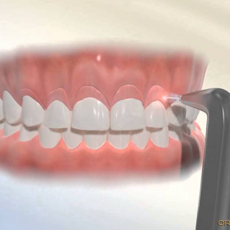 Gummy Smile Correction