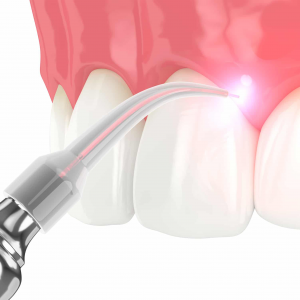 Tooth Sensitivity 
