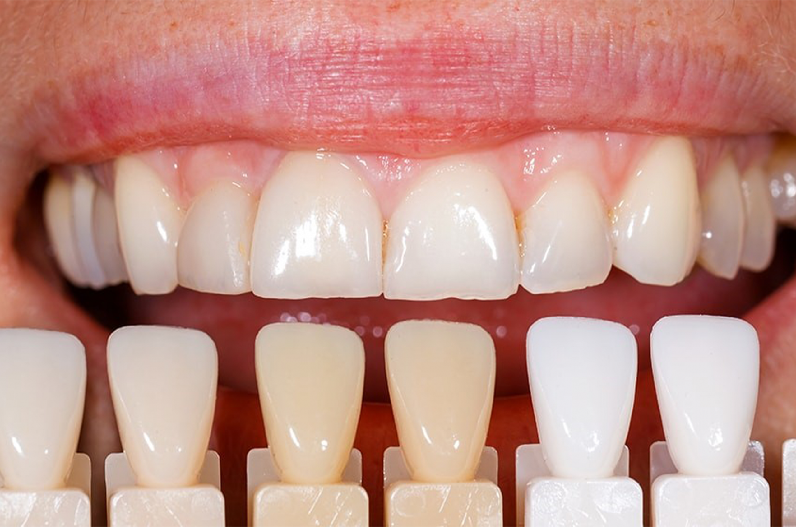 Porcelain Veneers