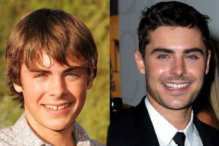 a photo of a celebrity before and after having adult orthodontics 