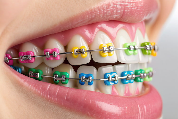 a photo showing the best colors for braces 