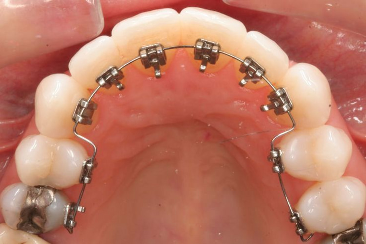 a photo showing lingual hidden braces which is a type of adult orthodontics 