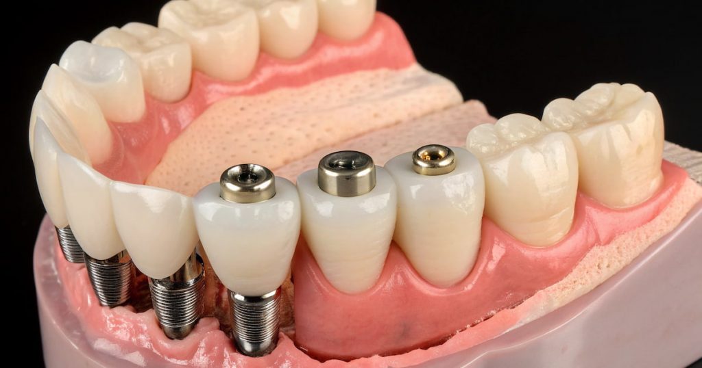a photo of hybrid dental bridges or a Hybridge