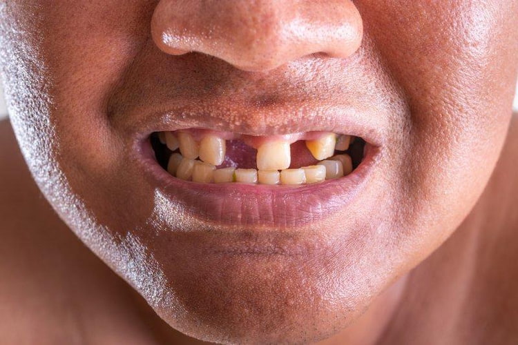 a photo of a person with tooth loss in need of a Hybridge