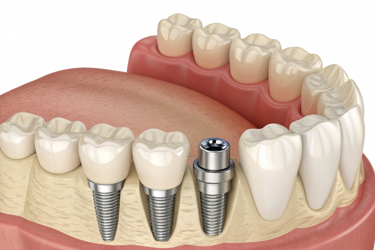 a photo showing how a Hybridge works  