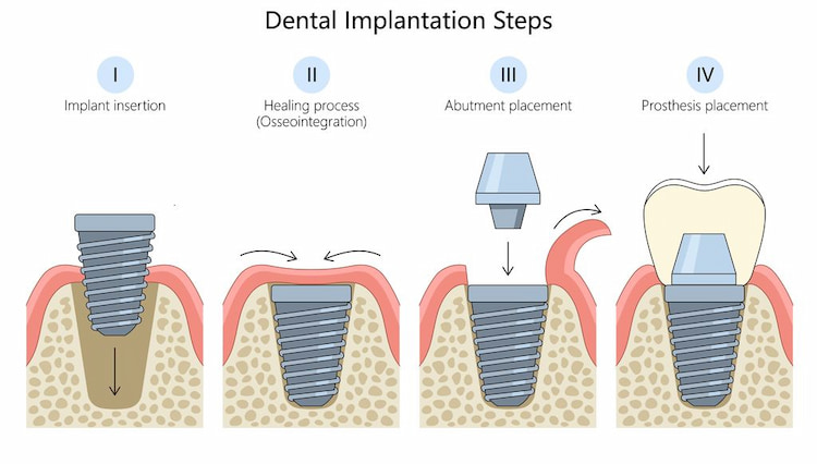 a diagram showing what to expect during the endosteal implant process