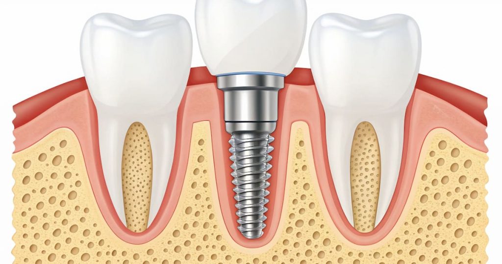 a photo of an artificial endosteal dental implant