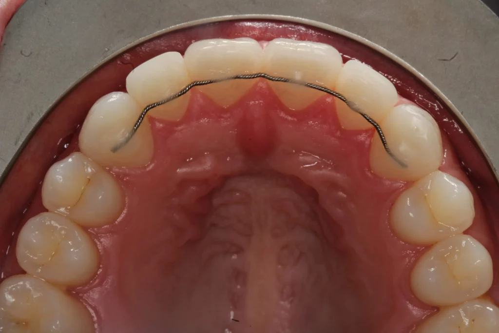 the retention phase after braces