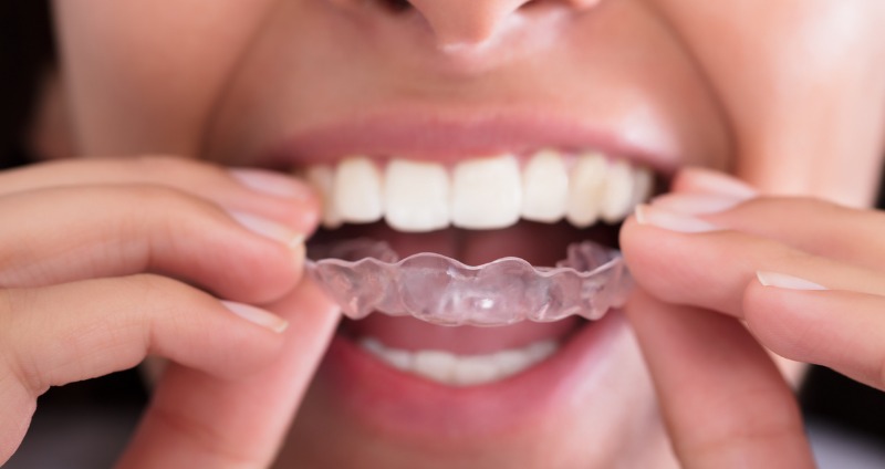 The retention phase after braces explained by dentists