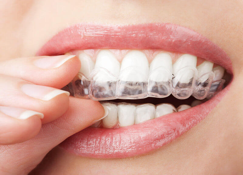 Invisalign Timeline