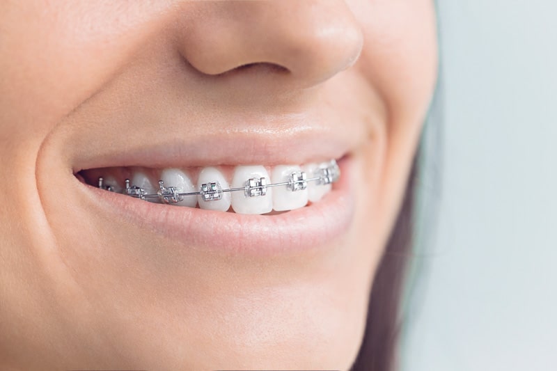 Traditional Braces Timeline